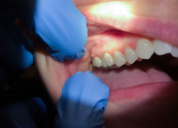 Best Cracked Tooth Emergency Dentist  in Grayling, MI